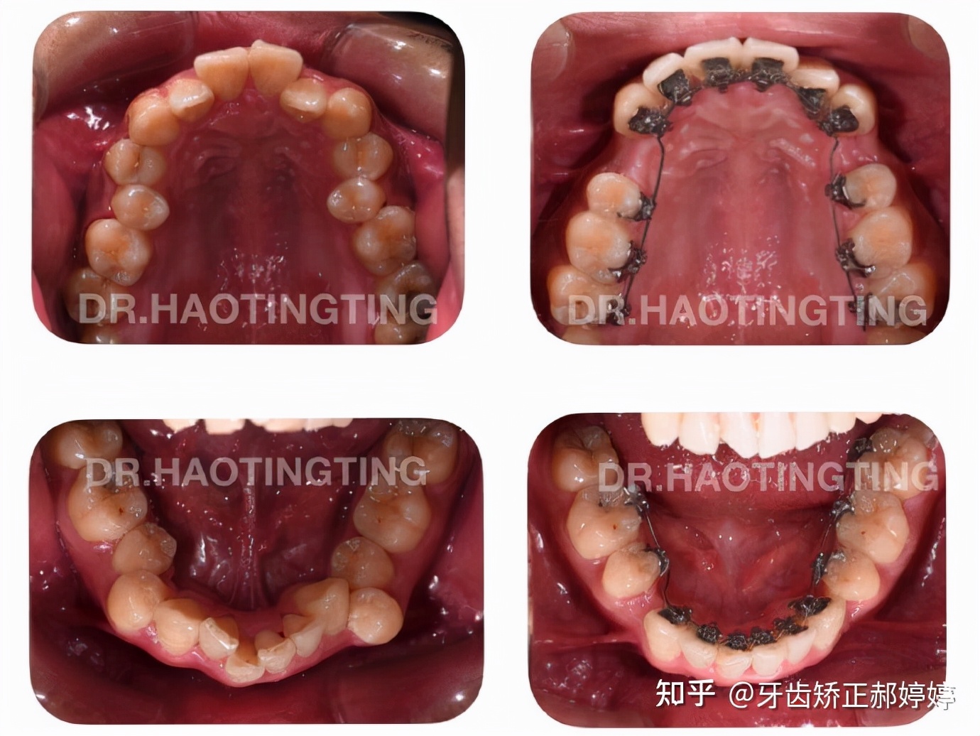 上海成人牙齿矫正失败案例,上海牙齿矫正郝婷婷医生