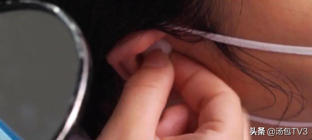 意外！男子掏耳不慎致棉花堵塞“弯道”