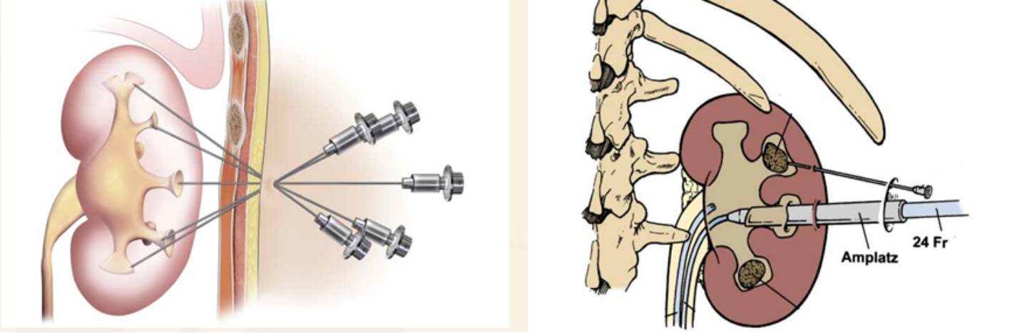 疯狂的石头碎石,疯狂的石头包世宏结石