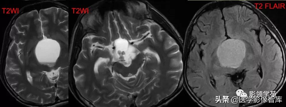 鞍区肿瘤做什么检查得出来,鞍区肿瘤的影像学鉴别