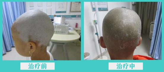 小女孩不慎染上怪病,儿童初发白斑的治愈率