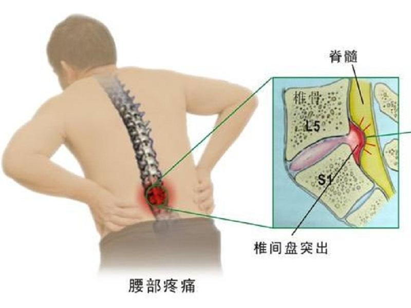 腰椎突出和膨出脱出图片,腰椎间盘突出脱出膨出的区别