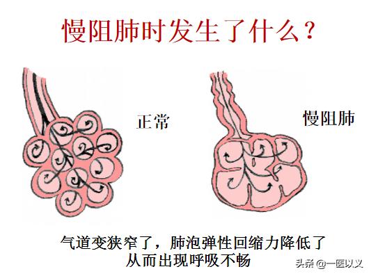 肺气肿慢阻肺最佳治疗方案,慢阻肺肺气肿稳定期怎么治疗