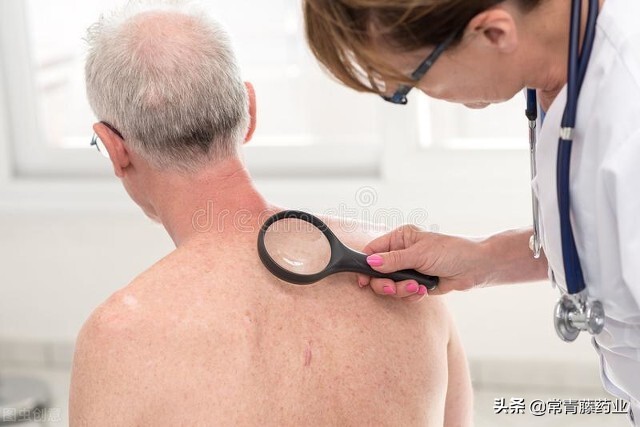 银屑病用药无效怎么办？医生：这7种药极为有效，但是副作用大