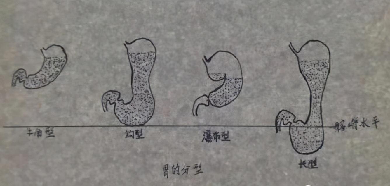 ​武汉一男子弯腰就能缓解胃痛？原来他长了个瀑布胃