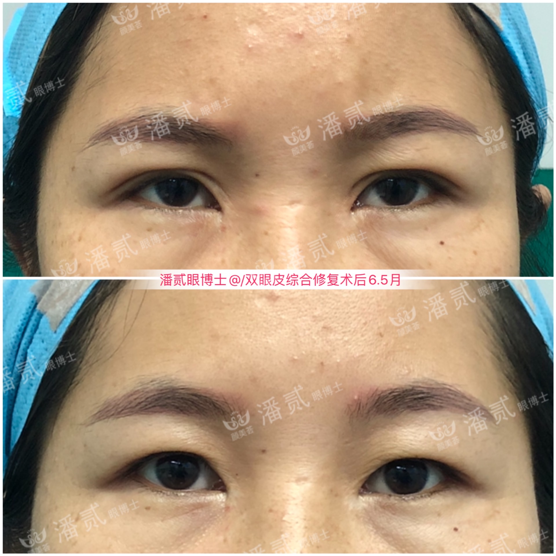 双眼皮术后变内双怎么办,双眼皮术后为啥变内双了