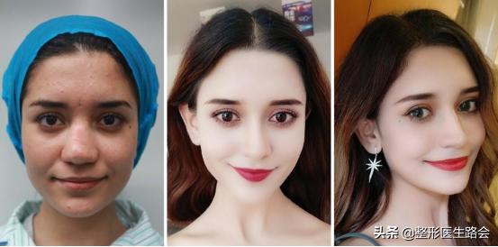 鼻翼缩小和鼻翼缩小之后的对比,超有效的缩小鼻翼的方法