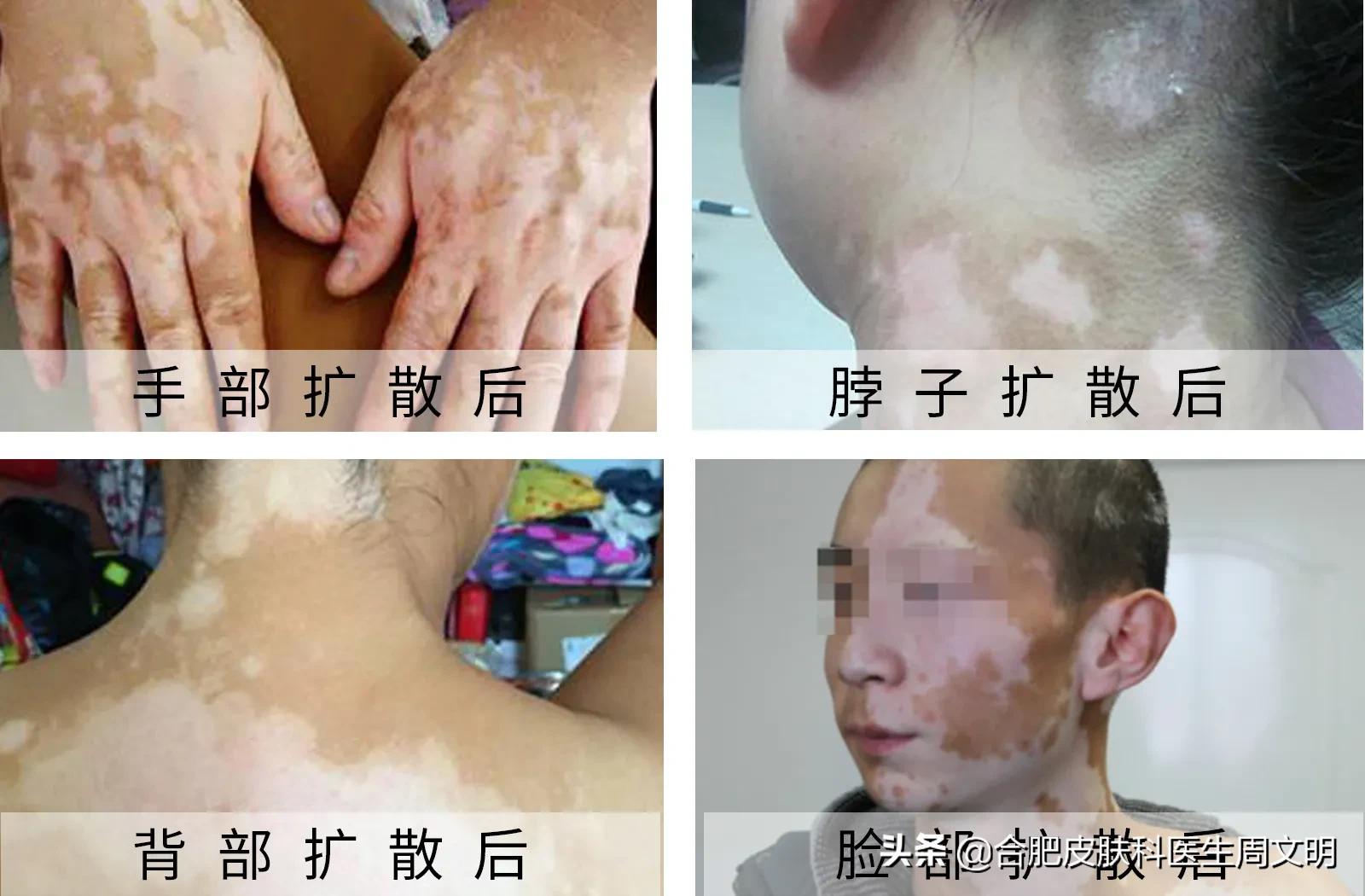 白癜风是皮肤病难治的第几种,鼻子下方嘴巴上的白癜风难治吗