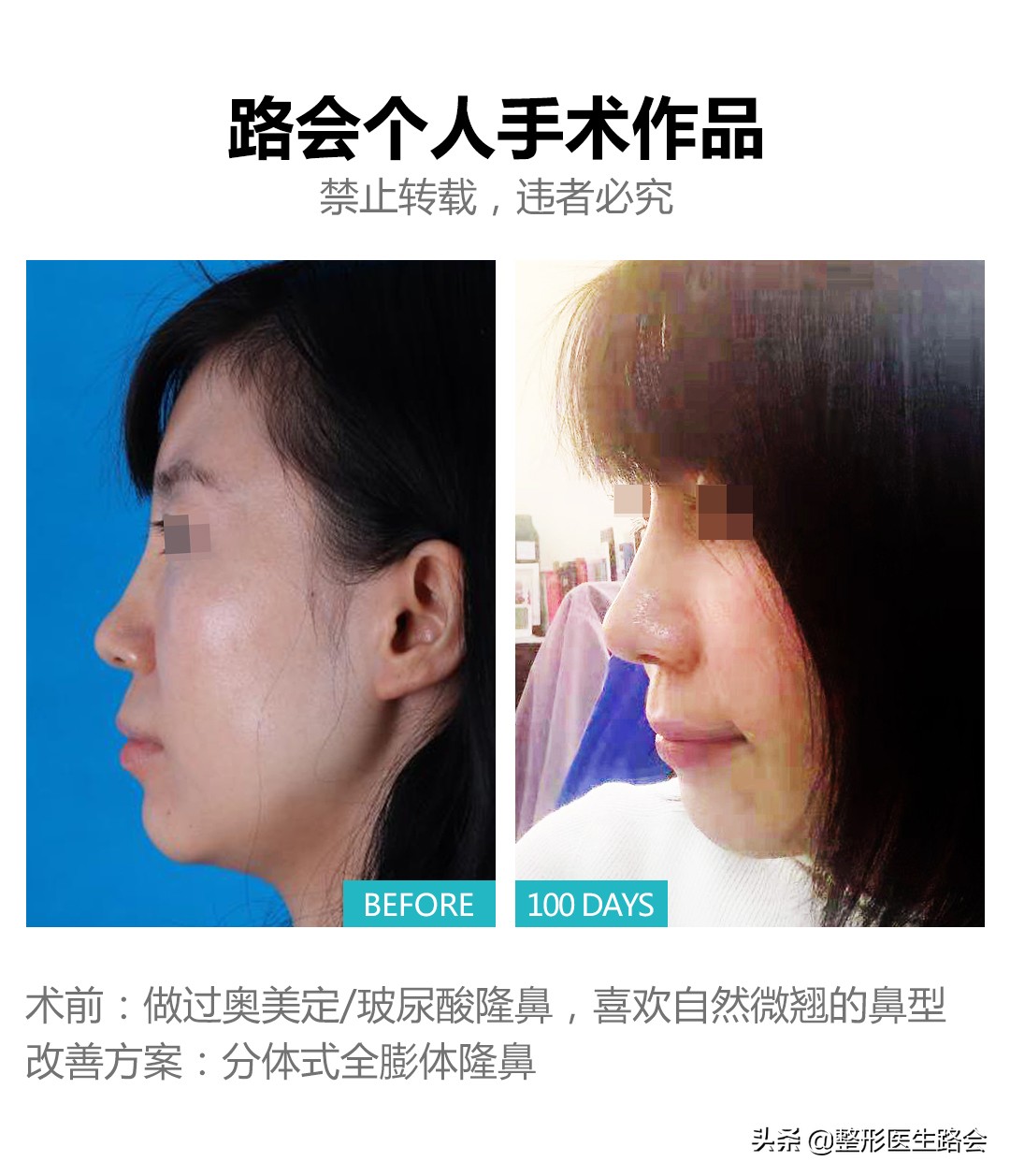 假体鼻子假吗,假体真的假吗