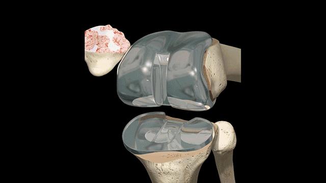 膝盖弯曲总是响是怎么回事,走路膝盖咯咯响有什么治疗方法