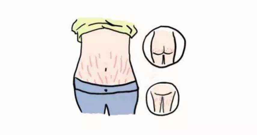 怀孕长妊娠纹肚皮痒怎么回事,孕早期肚皮痒是不是要长妊娠纹