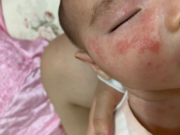 夏天到了,宝宝湿疹不好痱子也来了怎么办?5个方法告诉你。