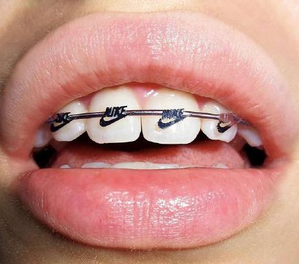 戴牙套不一定变好看,戴牙套难看吗