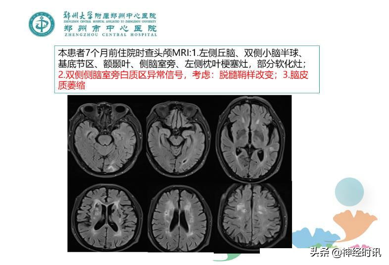 静脉溶栓怎么引起的,静脉相关并发症的预防及处理