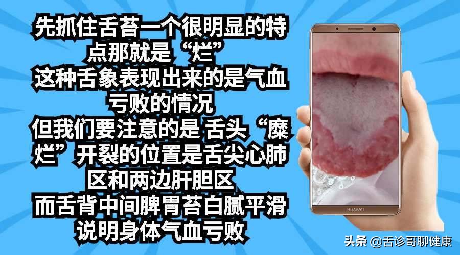 抖音舌诊哥舌象感悟:强迫症、大便不成型、忧心忡忡