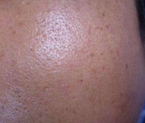 打败毛孔！下一个反孔精英就是你！