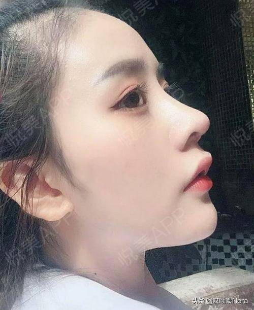 最自然的小翘鼻,鼻综合小翘鼻图片