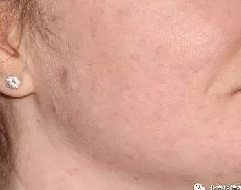 光子嫩肤唤醒肌肤活力重塑娇颜,光子嫩肤让你焕颜一新