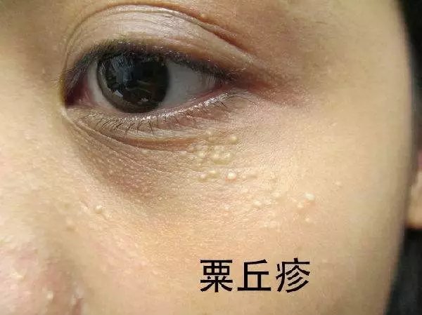 眼睛上长了黄色小粒,眼睛里面有黄色的麦粒肿怎么搞