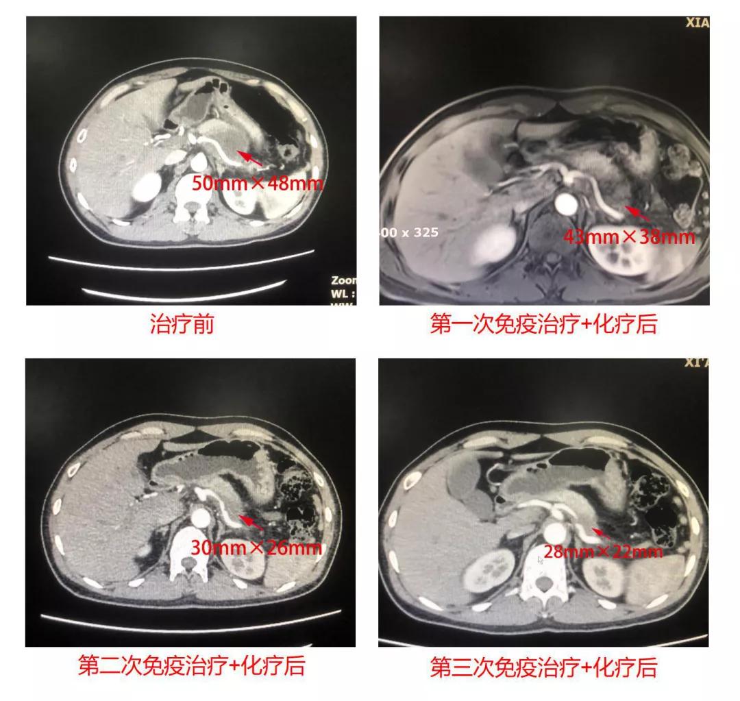 肝转移抗癌成功,万癌之王