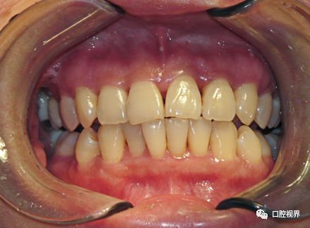 听说牙缝太大难看又露财，您给看看这牙缝还有救吗？