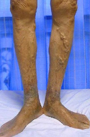 脚踝骨处烂了一个洞,老人的脚趾烂了个洞