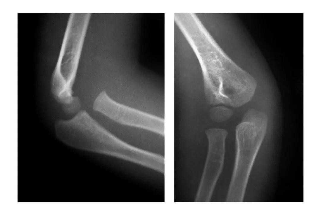 青少年肘部损伤最常见的是,肘部桡神经损伤的临床表现