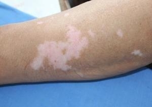 小伙子百般寻求良方，自己做自己的医生，却惨遭白癜风报复