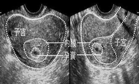 怀孕一般几周可以看到孕囊,孕囊大小判断大孕囊还是小孕囊