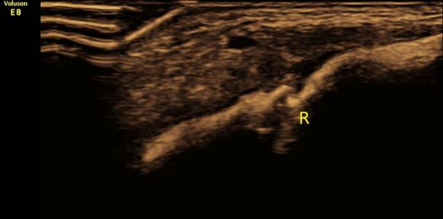 新生儿锁骨骨折的常见原因,新生儿锁骨骨折治疗方案