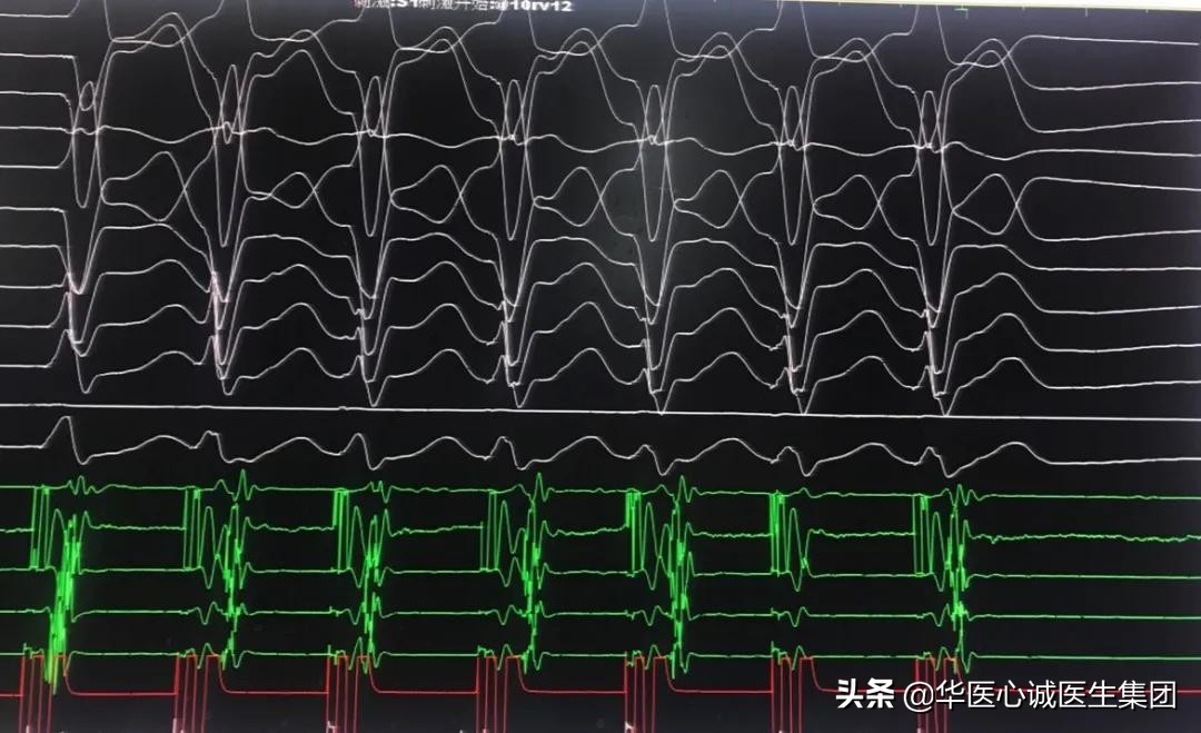 窦性心动过速查房,攀钢集团总医院心内科