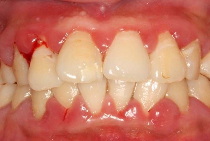 一碰就出血不易止住,轻轻一碰就出血是什么原因