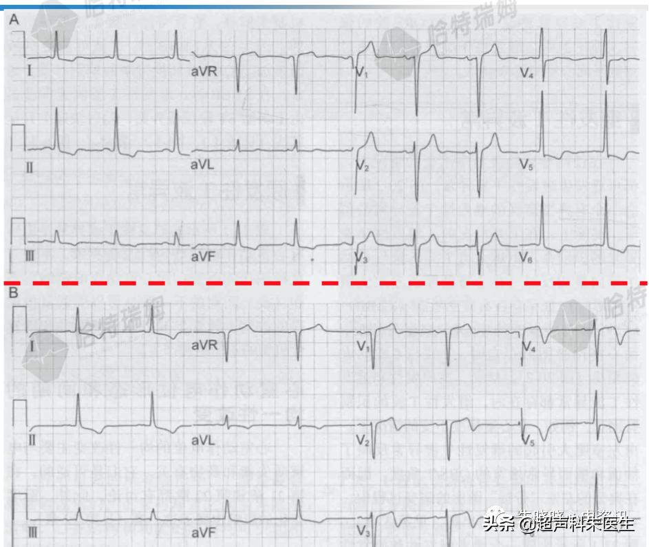 t波倒置诊断,t波倒置如何区分严重程度