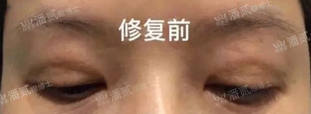 双眼皮失败眼角处有褶皱,双眼皮失败后闭眼痕迹