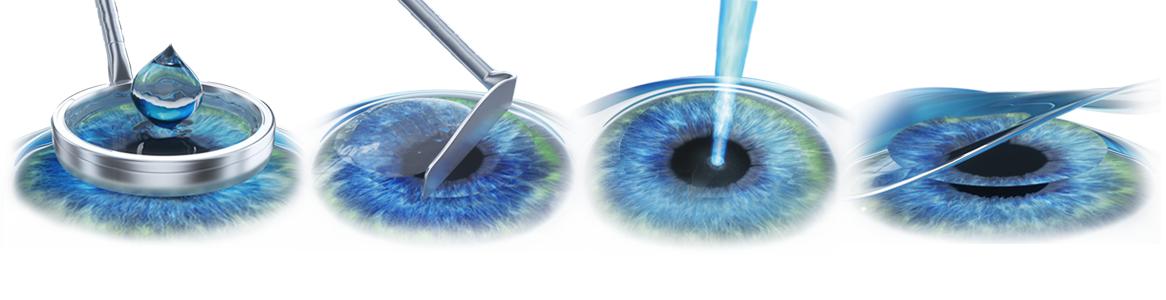 近视眼激光手术十大危害,近视眼手术真安全吗文章