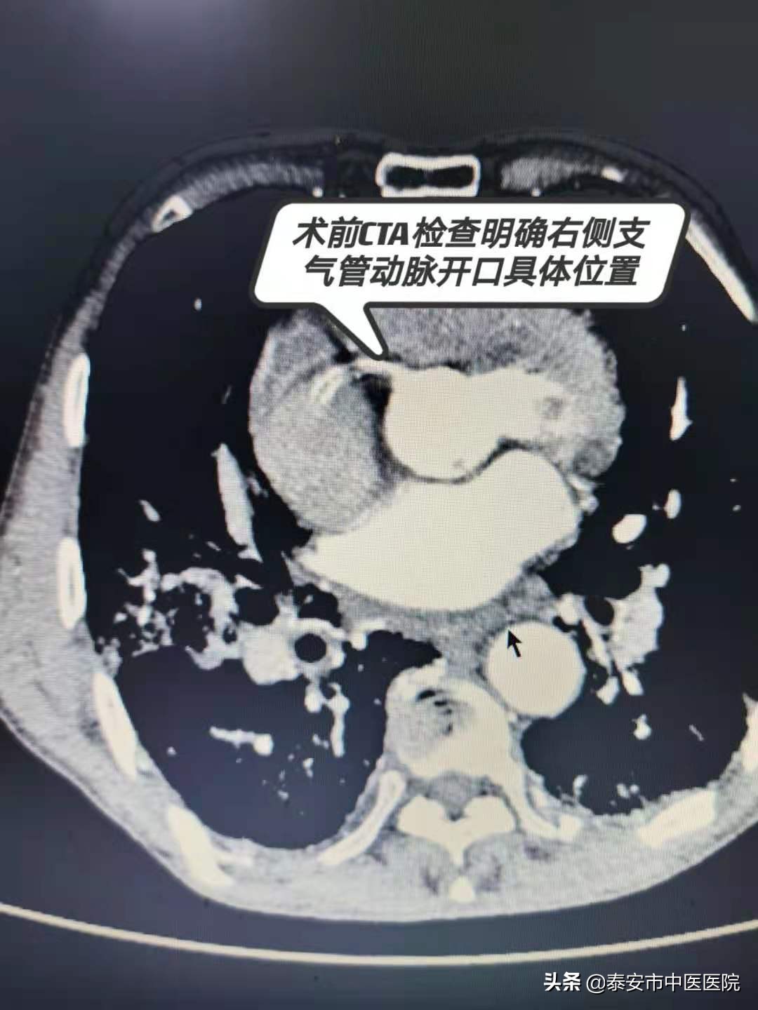 咳血要做微创手术吗,咳血需要做介入疗法吗