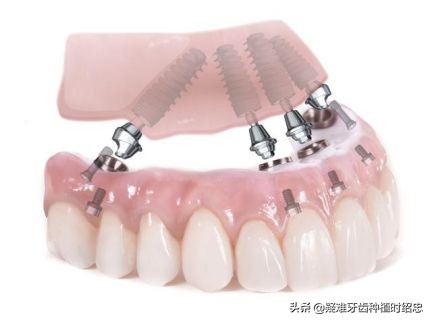 老人也可能种植牙齿吗,老年人骨质疏松能种牙吗