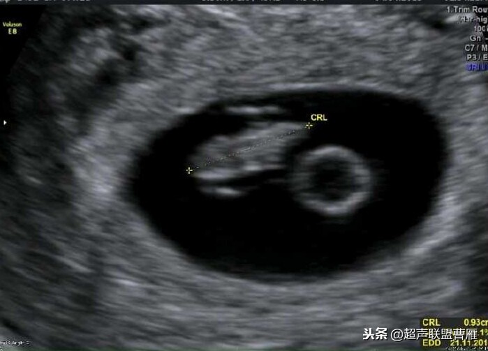 3毫米卵黄囊未见胎芽正常么,40多天的卵黄囊