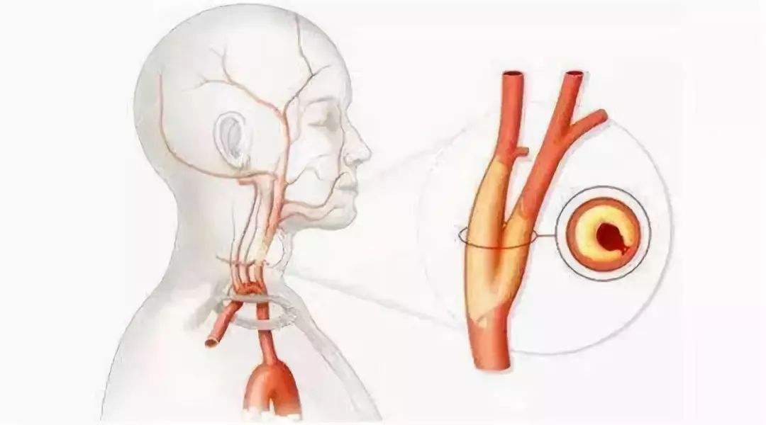 心血管狭窄用中药可以治愈吗,中药可以治疗血管狭窄吗