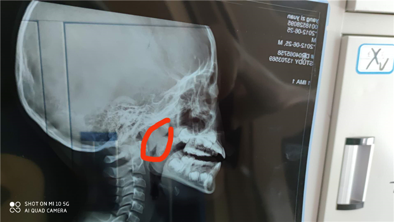 华西治疗打鼾最厉害的医生,华西治疗打鼾会先睡眠监测吗