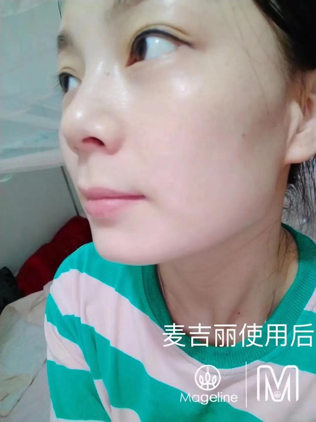 甜甜专业祛斑祛痘,甜甜祛斑直播间