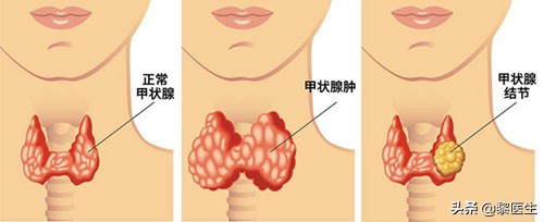 结婚一年后呕吐一个月以为是有喜，结果一查是肿瘤