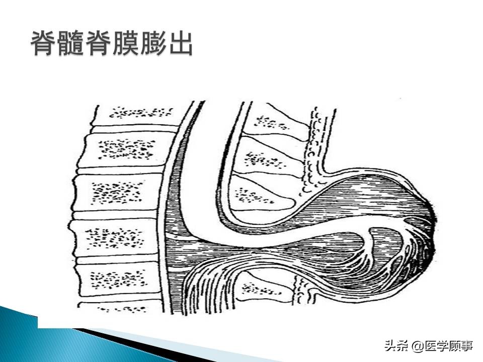 先天性脊柱裂是怎么来的,先天性脊柱裂的孕妇