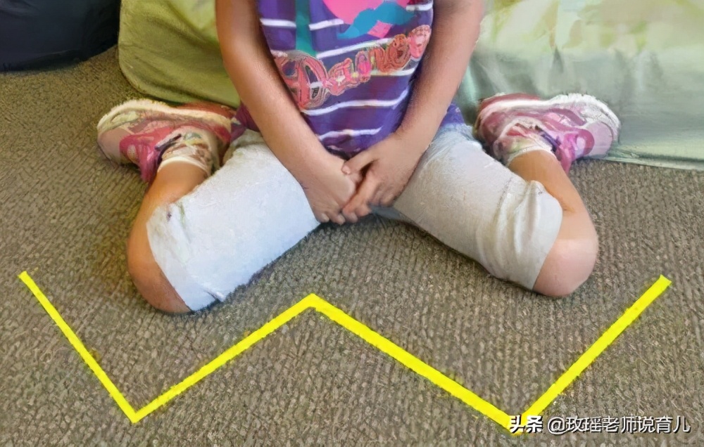 孩子o型腿走路内八,儿童矫正o型腿坐姿