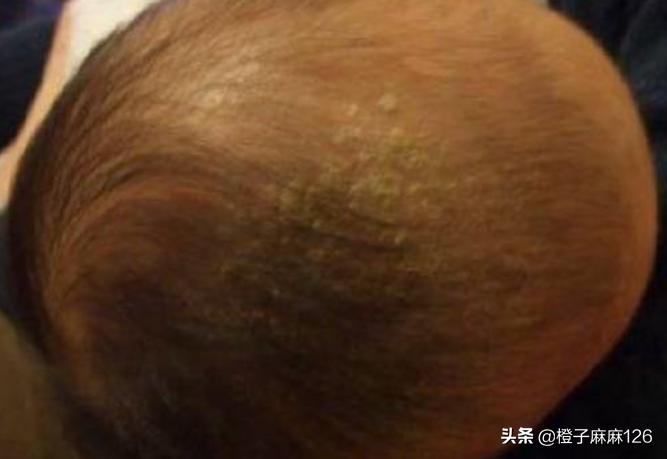 婴儿脸上起疹子跟母乳有关系吗,婴儿脸上有小疹子颗粒怎么消除