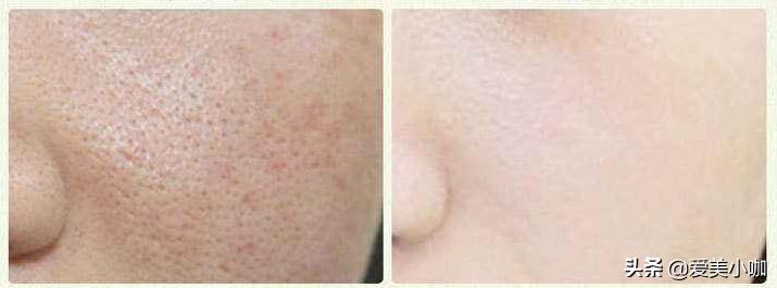 什么护肤品可以缩小毛孔,毛孔大护肤品真的可以缩小毛孔吗