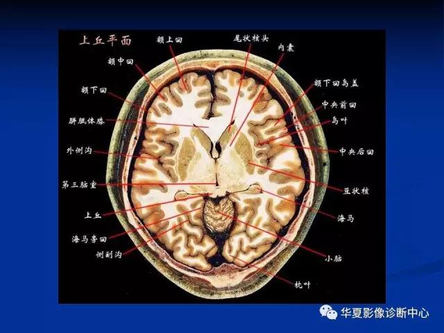 电子版头颅ct与mri断层解剖,头颅mri血管解剖与分段详解