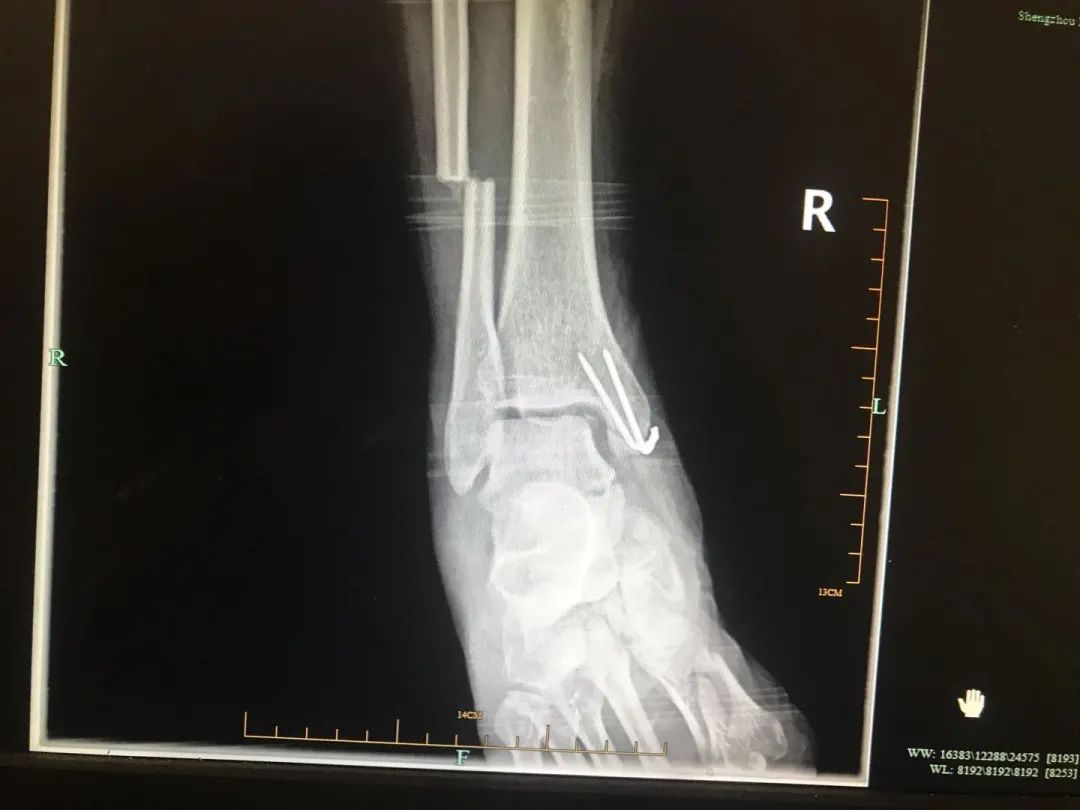 辽宁锦州患者跨数千公里到浙江嵊州只做简单手术背后有个故事