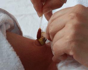 新生儿脐炎有脓怎么处理,新生儿脐炎肚脐渗水一般多久会好
