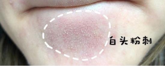 经常长粉刺闭口怎么内调,为什么会长闭口粉刺如何护肤